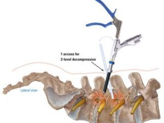 spine-spinal-canal-stenosis
